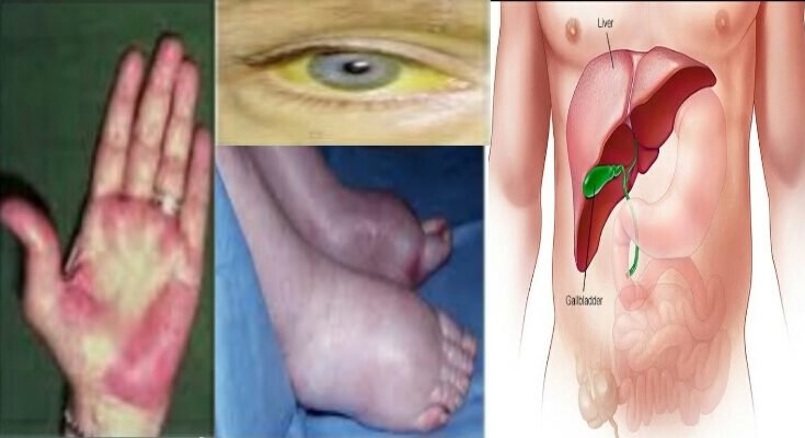 symptoms of liver infection